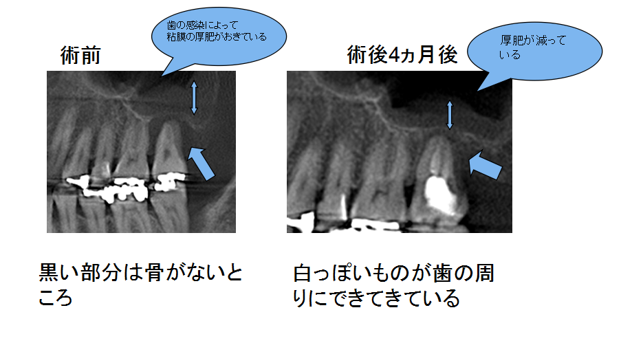 記事　上顎洞炎＋歯槽骨吸収　
